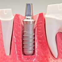 Dental Implant in Chennai