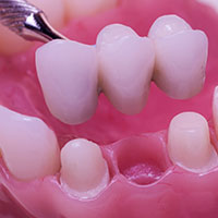 Teeth Replacement in Nungambakkam