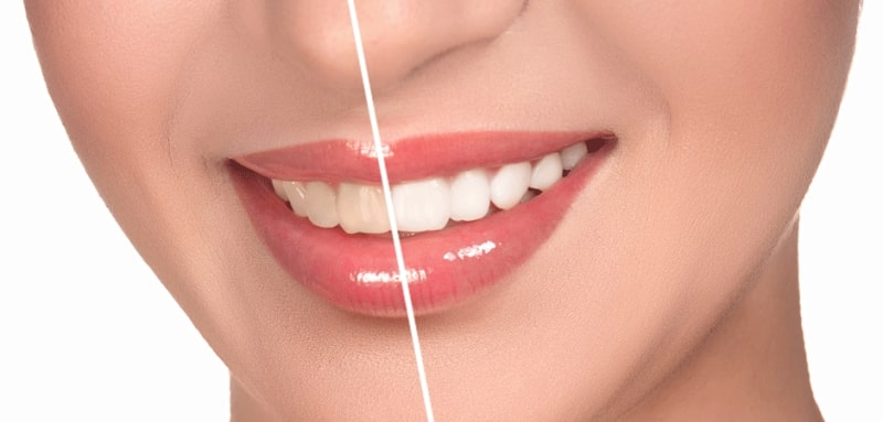 Cosmetic Dentistry in Chennai