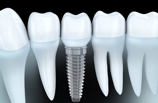 Dental-Implants Chennai