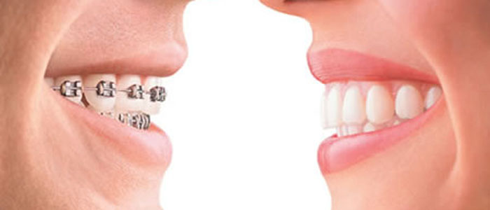 Orthodontist Treatment in chennai